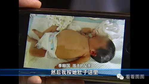 孕妇产下罕见胎中胎 胎中胎究竟是怎么形成的