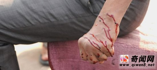 残忍且血腥:印度奇怪的“放血”疗法