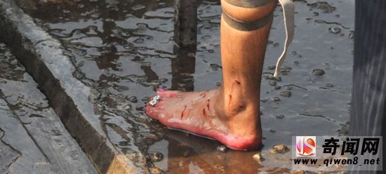 残忍且血腥:印度奇怪的“放血”疗法