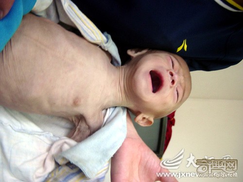 半岁婴儿皮肤皱如老翁